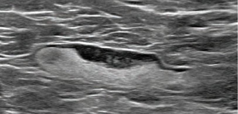 COVID 19 Vaccination Axillary Adenopathy Detected During Breast